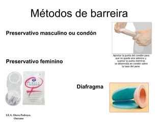Métodos de barreira
Preservativo masculino ou condón
Preservativo feminino
Diafragma
I.E.S. Otero Pedrayo.
Ourense
 