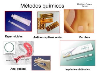 Métodos químicos
I.E.S. Otero Pedrayo.
Ourense
Espermicidas Anticonceptivos orais Parches
Anel vaxinal Implante subdérmico
 