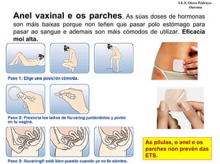 Anel vaxinal e os parches. As súas doses de hormonas
son máis baixas porque non teñen que pasar polo estómago para
pasar ao sangue e ademais son máis cómodos de utilizar. Eficacia
moi alta.
As pílulas, o anel e os
parches non prevén das
ETS.
I.E.S. Otero Pedrayo.
Ourense
 
