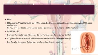  HPV
 O Papiloma Vírus Humano ou HPV, é uma das Infecções sexualmente transmissíveis (IST) mais
conhecidas.
Pode provocar desde verrugas na pele e genitais até o câncer de colo de útero.
 BARTOLINITE
 É uma inflamação nas glândulas de Bartholin gerando os cistos de Bartholin.
 As glândulas de Bartholin se encontram nas laterais da entrada da vagina.
 Sua função é secretar fluido que ajuda na lubrificação vaginal.
 