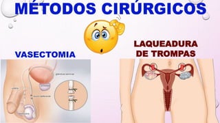 VASECTOMIA
LAQUEADURA
DE TROMPAS
 