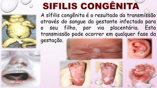 SIFILIS CONGÊNITA
A sífilis congênita é o resultado da transmissão
através do sangue da gestante infectada para
o seu filho, por via placentária. Esta
transmissão pode ocorrer em qualquer fase da
gestação.
 