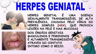 HERPES GENITAL É UMA DOENÇA
SEXUALMENTE TRANSMISSÍVEL DE ALTA
PREVALÊNCIA, CAUSADA PELO VÍRUS DO
HERPES SIMPLES (HSV), QUE PROVOCA
LESÕES NA PELE E NAS MUCOSAS
DOS ÓRGÃOS GENITAIS
MASCULINOS E FEMININOS
É ALTAMENTE TRANSMISSÍVEL
ATRAVES DO CONTATO
INTIMO COMO O BEIJO.
 