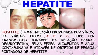 HEPATITE É UMA INFECÇÃO PROVOCADA POR VÍRUS,
HÁ VÁRIOS TIPOS: A B e C. PODE SER
TRANSMITIDO ATRAVÉS DA RELAÇÃO SEXUAL
DESPROTEGIDA, PELAS FEZES, ALIMENTOS E ÁGUA
CONTAMINADA E ATRAVÉS DE OBJETOS DE PESSOA
PORTADORA DE HEPATITE.
 