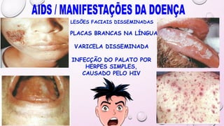 LESÕES FACIAIS DISSEMINADAS
PLACAS BRANCAS NA LÍNGUA
INFECÇÃO DO PALATO POR
HERPES SIMPLES,
CAUSADO PELO HIV
VARICELA DISSEMINADA
 
