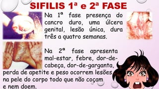 SIFILIS 1ª e 2ª FASE
Na 1ª fase presença do
cancro duro, uma úlcera
genital, lesão única, dura
três a quatro semanas.
Na 2ª fase apresenta
mal-estar, febre, dor-de-
cabeça, dor-de-garganta,
perda de apetite e peso ocorrem lesões
na pele do corpo todo que não coçam
e nem doem.
 