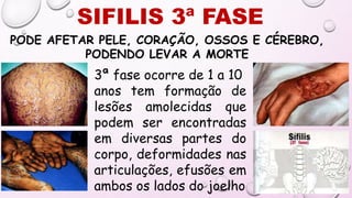SIFILIS 3ª FASE
PODE AFETAR PELE, CORAÇÃO, OSSOS E CÉREBRO,
PODENDO LEVAR A MORTE
3ª fase ocorre de 1 a 10
anos tem formação de
lesões amolecidas que
podem ser encontradas
em diversas partes do
corpo, deformidades nas
articulações, efusões em
ambos os lados do joelho
 