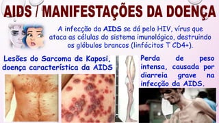 Lesões do Sarcoma de Kaposi,
doença característica da AIDS
Perda de peso
intensa, causada por
diarreia grave na
infecção da AIDS.
A infecção da AIDS se dá pelo HIV, vírus que
ataca as células do sistema imunológico, destruindo
os glóbulos brancos (linfócitos T CD4+).
 