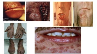 Congenital Syphilis
• Congenital syphilis usually
occurs following vertical
transmission of T. pallidum
from the infected mother to
the fetus in utero, but neonates
may also be infected during
passage through the infected
birth canal at delivery.
 