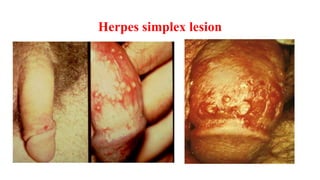 Gonorrhoea
Clinical Manifestations
• Urethritis - male
– Incubation: 1-14 d (usually 2-5 d)
– Sx: Dysuria and urethral discharge (5% asymptomatic)
– Dx: Gram stain urethral smear (+) > 98% culture
– Complications
• Urogenital infection - female
– Endocervical canal primary site
– 70-90% also colonize urethra
– Incubation: unclear; symptoms usually in l0 d
– Sx: majority asymptomatic; may have vaginal discharge, dysuria, urination, labial
pain/swelling, abd. pain
– Dx: Gram stain smear (+) 50-70% culture
 