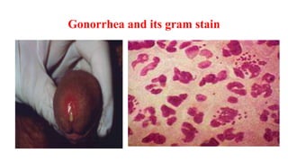 Nongonococcal Urethritis
Etiology:
– 20-40% C. trachomatis
– 20-30% genital mycoplasmas (Ureaplasma urealyticum, Mycoplasma genitalium)
– Occasional Trichomonas vaginalis, HSV
– Unknown in ~50% cases
• Sx: Mild dysuria, mucoid discharge
• Dx: Urethral smear 5 PMNs (usually 15)/OI field
• Urine microscopic 10 PMNs/HPF
• Leukocyte esterase (+)
 