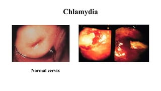 Pelvic Inflammatory Disease (PID)
• l0%-20% women PID
• CDC minimal criteria
• – uterine adnexal tenderness, cervical motion tenderness
• Other symptoms include
– endocervical discharge, fever, lower abd. pain
• Complications:
– Infertility: 15%-24% with 1 episode PID secondary to GC or chlamydia
 