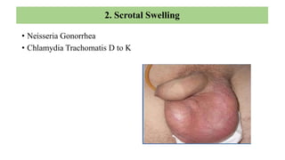 • HISTORY
Scrotal swelling & pain
Pain or burning micturition
Malaise, fever
Oro-genital sex
• EXAMINATION
Scrotal swelling
Redness and edema of overlying skin
Tenderness – epididymis & V. deferens
Discharge, ulcer, inguinal nodes
Trans-illumination test-to rule out
hydrocoele.
DIFFERENTIAL DIGNOSIS
Scrotal swelling – Infectious causes
TB, filariasis, coliforms, pseudomonas,
mumps
Non infectious causes
Trauma, hernia, hydrocoele, Testicular
torsion/ tumour
 