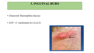 HISTORY
• Inguinal swelling (painful)
• Preceding ulcer / discharge
• Malaise, fever
• Oro-genital sex
EXAMINATION
• Enlarged inguinal nodes – tender fluctuant
• Redness and edema of skin
• Multiple sinuses
• Oedema – genital & lower limb
• Genital ulcer / discharge
DIFFERENTIAL DIAGNOSIS
• TB, Filariasis
• Acute infection – pubic area, genitals,
buttocks,anus, lower limb
• Suspected malignancy (or) TB –
biopsy
 