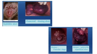 • TREATMENT
• Herpes : T. Acyclovir 400mg TDS x 7D ORALLY
• Syphilis:
Inj Benzathine penicillin 2.4 million IU IM in two divided dose (or)
Doxycycline 100mg BD x 14D
+
T. Azithromycin 1g single dose
(or)
T.Ciprofloxacin 500mg BD x 3D
(to cover Chancroid)
TREATMENT SHOULD BE EXTENDED BEYOND 7 DAYS IF
ULCER IS NOT EPITHELIALIZED .
PARTNER MANAGEMENT
• Treat all recent partner
(with in 3 months).
• Sexual abstinence / use of
condom.
• Testing for HIV, Hepatitis B.
• Follow up – in a week’s time
 