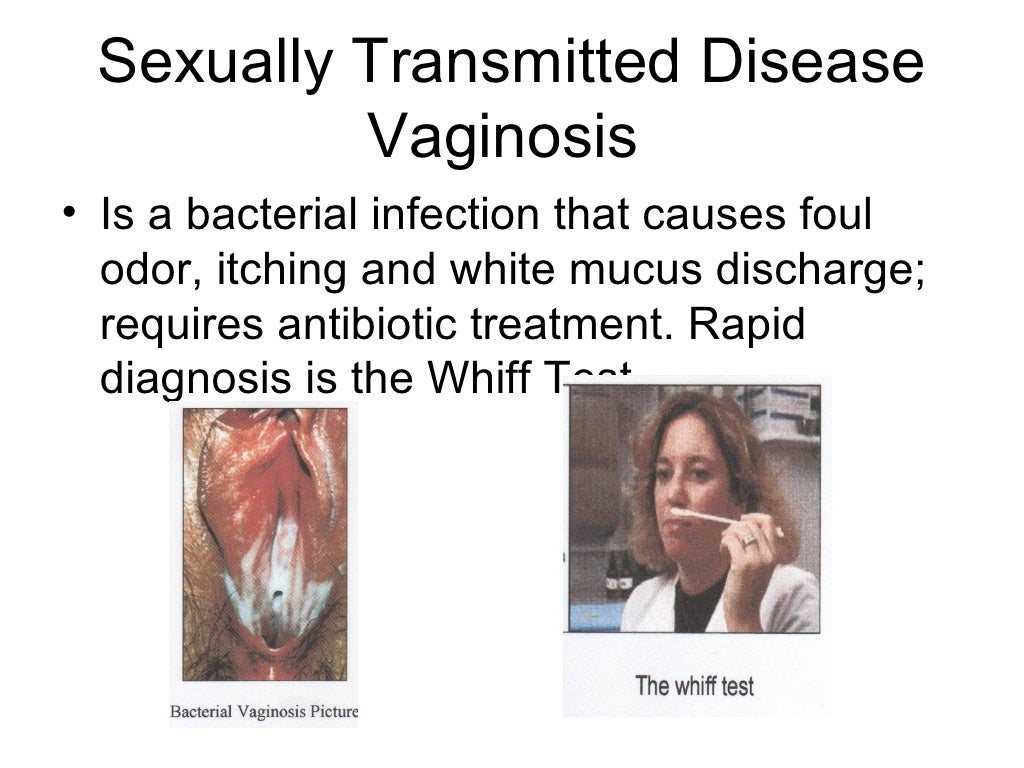 Sexually transmitted disease