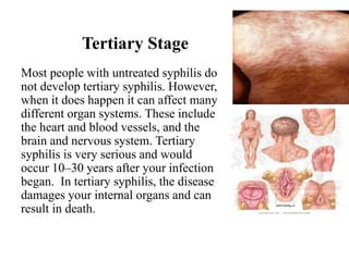 Tertiary Stage
Most people with untreated syphilis do
not develop tertiary syphilis. However,
when it does happen it can affect many
different organ systems. These include
the heart and blood vessels, and the
brain and nervous system. Tertiary
syphilis is very serious and would
occur 10–30 years after your infection
began. In tertiary syphilis, the disease
damages your internal organs and can
result in death.
 