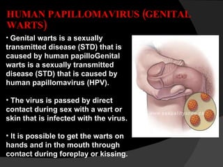 HUMAN PAPILLOMAVIRUS (GENITAL WARTS) Genital warts is a sexually transmitted disease (STD) that is caused by human papilloGenital warts is a sexually transmitted disease (STD) that is caused by human papillomavirus (HPV).  The virus is passed by direct contact during sex with a wart or skin that is infected with the virus.  It is possible to get the warts on hands and in the mouth through contact during foreplay or kissing. 