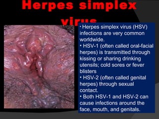 Herpes simplex virus Herpes simplex virus (HSV) infections are very common worldwide. HSV-1 (often called oral-facial herpes) is transmitted through kissing or sharing drinking utensils; cold sores or fever blisters HSV-2 (often called genital herpes) through sexual contact.  Both HSV-1 and HSV-2 can cause infections around the face, mouth, and genitals.  