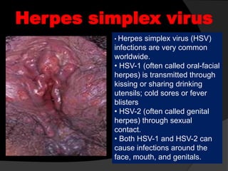 Herpes simplex virus
• Herpes simplex virus (HSV)
infections are very common
worldwide.
• HSV-1 (often called oral-facial
herpes) is transmitted through
kissing or sharing drinking
utensils; cold sores or fever
blisters
• HSV-2 (often called genital
herpes) through sexual
contact.
• Both HSV-1 and HSV-2 can
cause infections around the
face, mouth, and genitals.
 