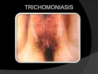 TRICHOMONIASIS
 