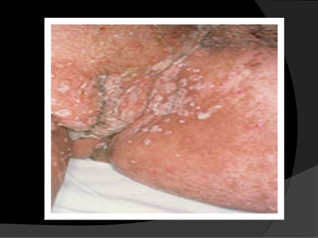 Young twink thumbnails Diseases passed by oral sex