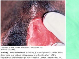 Sexually transmitted diseases (pictures) | PPT