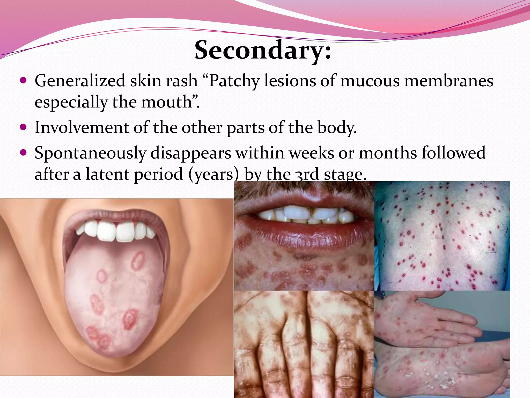 Secondary:
Generalized skin rash “Patchy lesions of mucous membranes
especially the mouth”.
Involvement of the other parts of the body.
Spontaneously disappears within weeks or months followed
after a latent period (years) by the 3rd stage.