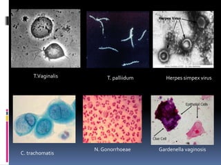 T.Vaginalis T. palliidum Herpes simpex virus
C. trachomatis
N. Gonorrhoeae Gardenella vaginosis
 