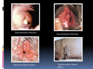 Gonnorhoeal infection
Gonnorhoeal infection
Herpes simplex lesions Papillomatous lesion
(HPV)
 