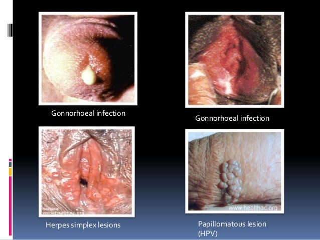 437737 hsv singles sexually transmitted disease