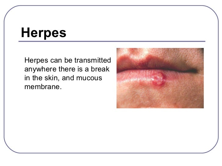 sex olie genital herpes sex olie genital herpes