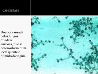 CANDIDÍASEDoença causada pelos fungos Candidaalbicans, que se desenvolvem num local quente e húmido da vagina.