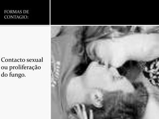 FORMAS DE CONTAGIO:Contacto sexual ou proliferação do fungo.