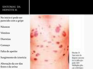 SINTOMAS  DA HEPATITE B:No inicio é pode ser parecido com a gripeNáuseasVómitosDiarreiasCansaçoFalta de apetiteSurgimento de icteríciaAlteração da cor das fezes e da urina