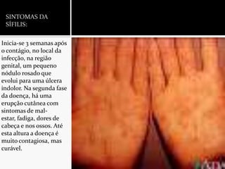 SINTOMAS DA SÍFILIS:Inicia-se 3 semanas após o contágio, no local da infecção, na região genital, um pequeno nódulo rosado que evolui para uma úlcera indolor. Na segunda fase da doença, há uma erupção cutânea com sintomas de mal-estar, fadiga, dores de cabeça e nos ossos. Até esta altura a doença é muito contagiosa, mas curável.