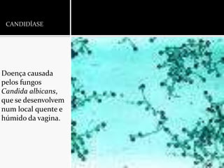 CANDIDÍASEDoença causada pelos fungos Candidaalbicans, que se desenvolvem num local quente e húmido da vagina.