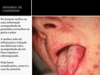 SINTOMAS  DE CANDIDÍASE:No homem verifica-se uma inflamação acompanhada de pontinhos vermelhos no pénis e ardor.A mulher sofre de inflamação e irritação nos lábios da vulva, acompanhado de um fluxo espesso e esbranquiçado.Pode haver complicações, como é o caso da ureterite.