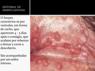 SINTOMAS  DE HERPES GENITAIS:O herpes caracteriza-se por vesículas, em forma de cacho, que aparecem 4 - 5 dias após o contágio, que acabam por rebentar e deixar a carne a descoberto.São acompanhadas por um ardor intenso.