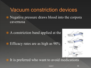  Negative pressure draws blood into the corpora
cavernosa
 A constriction band applied at the base
 Efficacy rates are as high as 90%
 It is preferred who want to avoid medications
1/8/2017 39
 