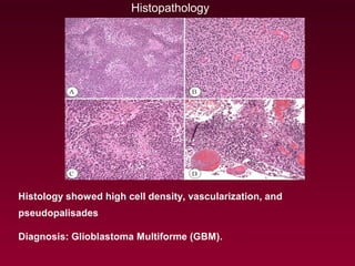 Histology showed high cell density, vascularization, and
pseudopalisades
Diagnosis: Glioblastoma Multiforme (GBM).
Histopathology
 
