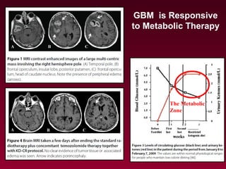 GBM is Responsive
to Metabolic Therapy
The Metabolic
Zone
 