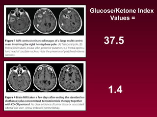 Glucose/Ketone Index
Values =
37.5
1.4
 