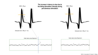 Nr Graph SFEMG Signal Atlas - Highlights - Stimulated - Pitfalls - VRF - Axon ...