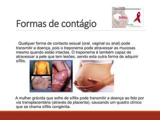 Formas de contágio 
Qualquer forma de contacto sexual (oral, vaginal ou anal) pode 
transmitir a doença, pois o treponema pode atravessar as mucosas 
mesmo quando estão intactas. O treponema é também capaz de 
atravessar a pele que tem lesões, sendo esta outra forma de adquirir 
sífilis. 
A mulher grávida que sofre de sífilis pode transmitir a doença ao feto por 
via transplacentária (através da placenta), causando um quadro clínico 
que se chama sífilis congénita. 
 