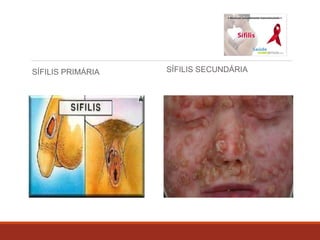 SÍFILIS PRIMÁRIA SÍFILIS SECUNDÁRIA 
 