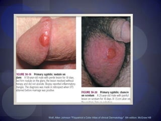 VSWolf, Allen Johnson "Fitzpatrick’s Color Atlas of clinical Dermatology"  6th edition. McGraw Hill