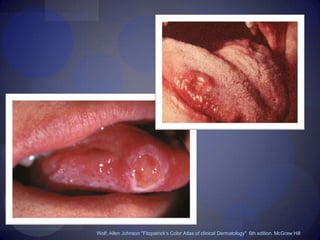 Wolf, Allen Johnson "Fitzpatrick’s Color Atlas of clinical Dermatology"  6th edition. McGraw Hill