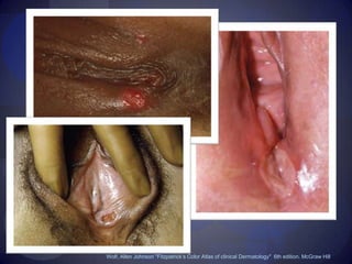 Wolf, Allen Johnson "Fitzpatrick’s Color Atlas of clinical Dermatology"  6th edition. McGraw Hill