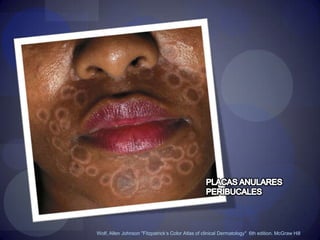 Wolf, Allen Johnson "Fitzpatrick’s Color Atlas of clinical Dermatology"  6th edition. McGraw Hill